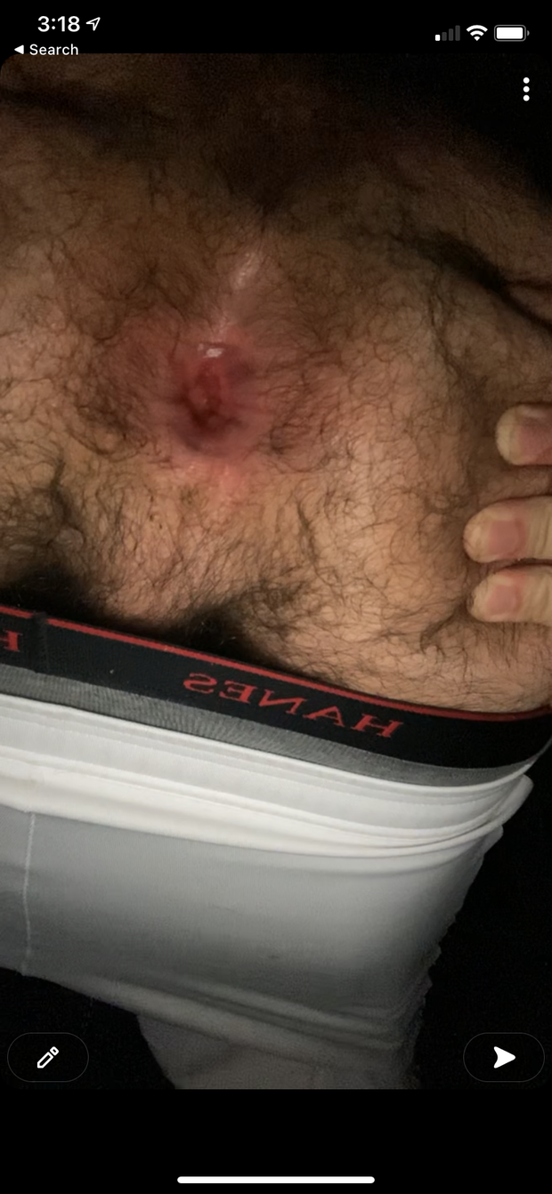 Straight anal gape