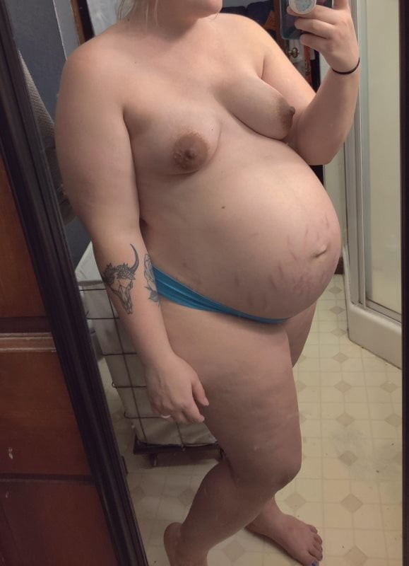Stretch marks