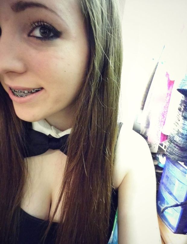 Teen braces