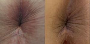 2 holes are better than 1