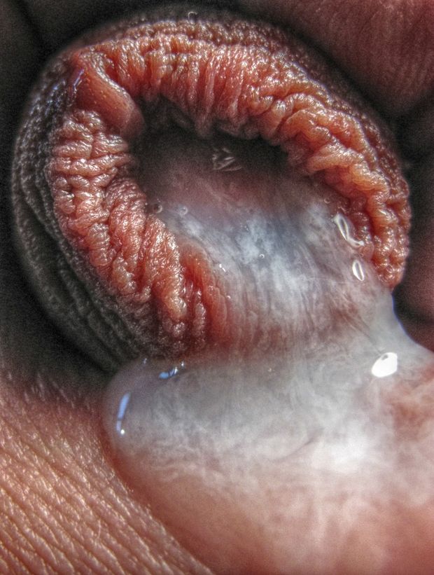 Leaky foreskin