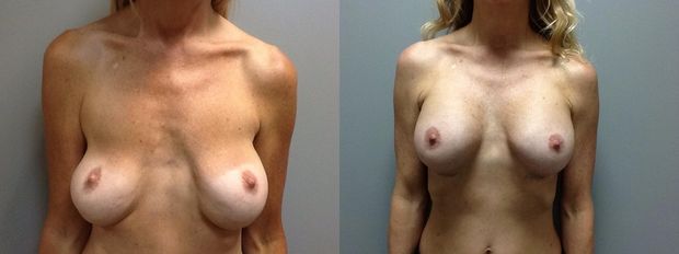 before-after new tits