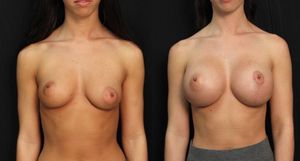 before-after new tits