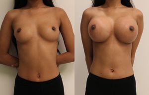 before-after new tits