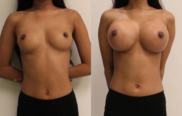 before-after new tits