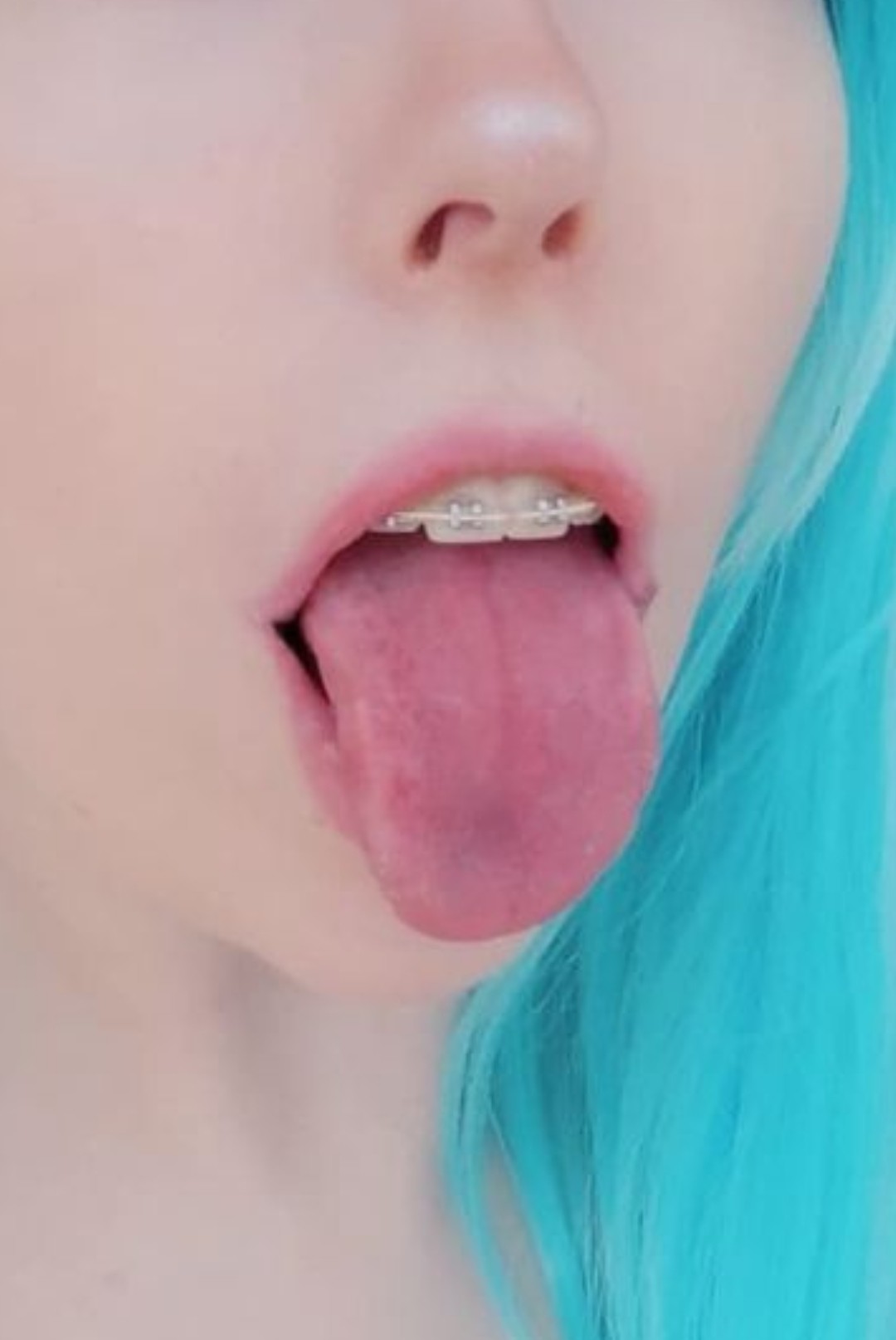 Braces tongue