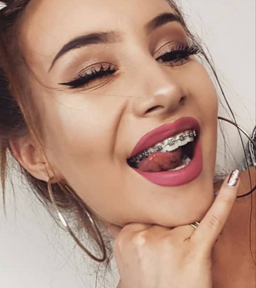 Braces tongue