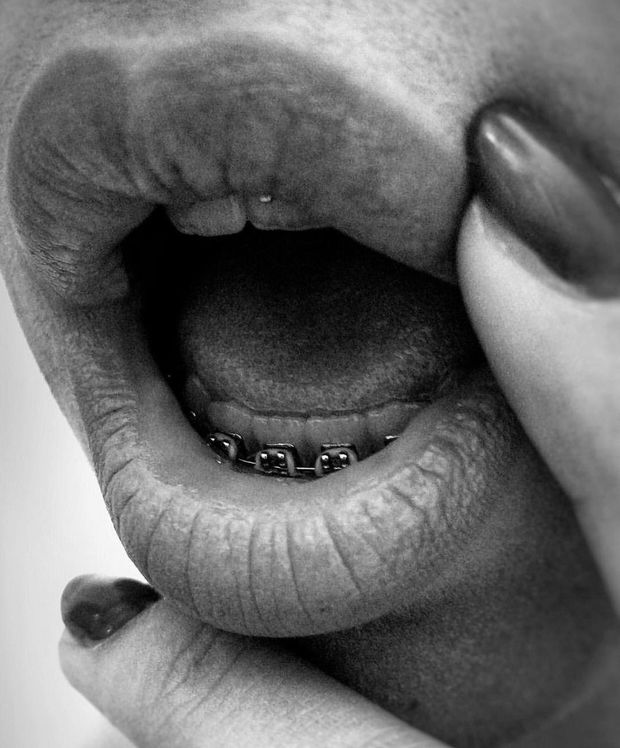 Braces mouth