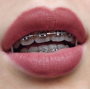 Braces lips