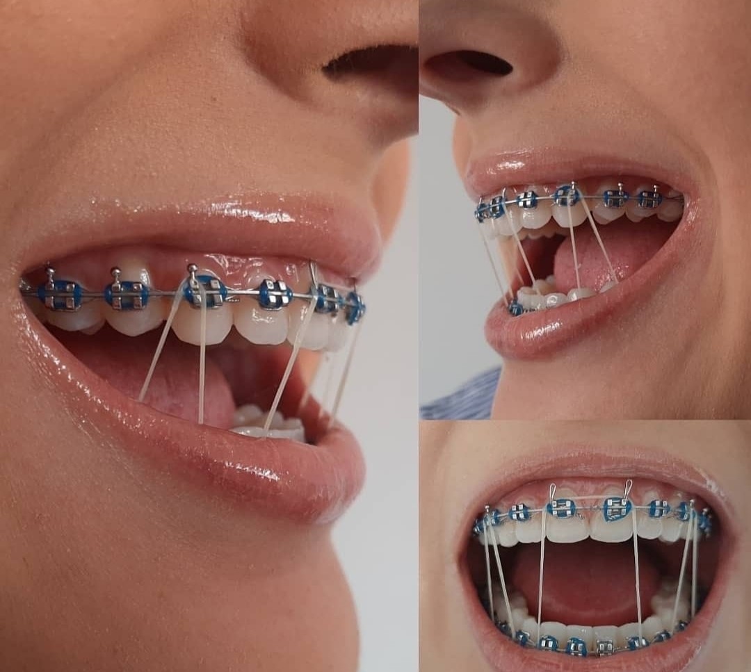 Braces elastics