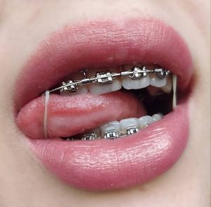 Braces mouth