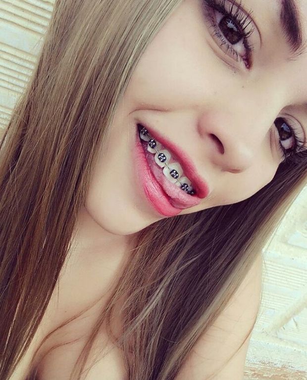 Braces tongue