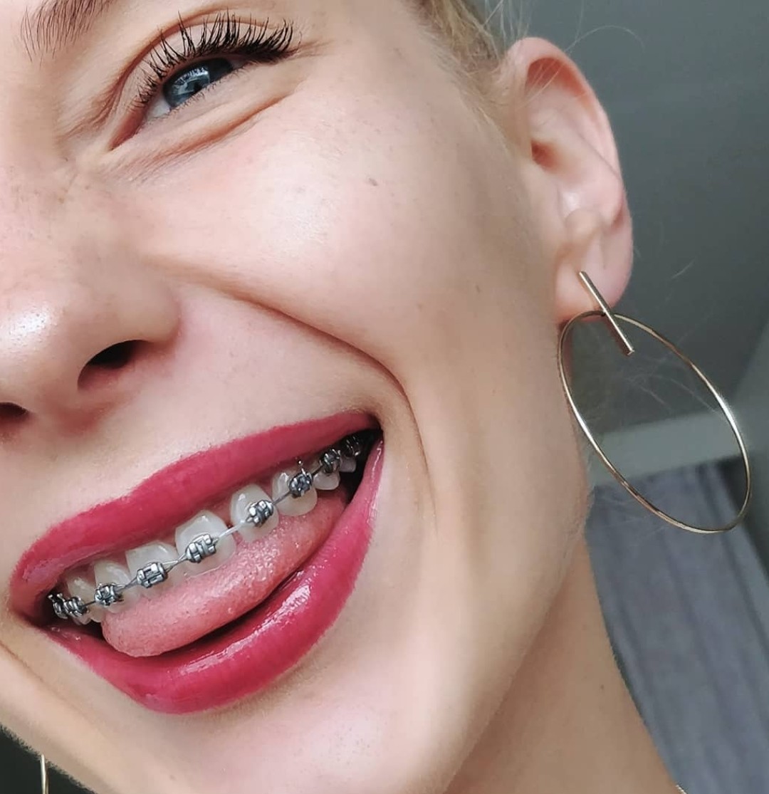 Braces tongue