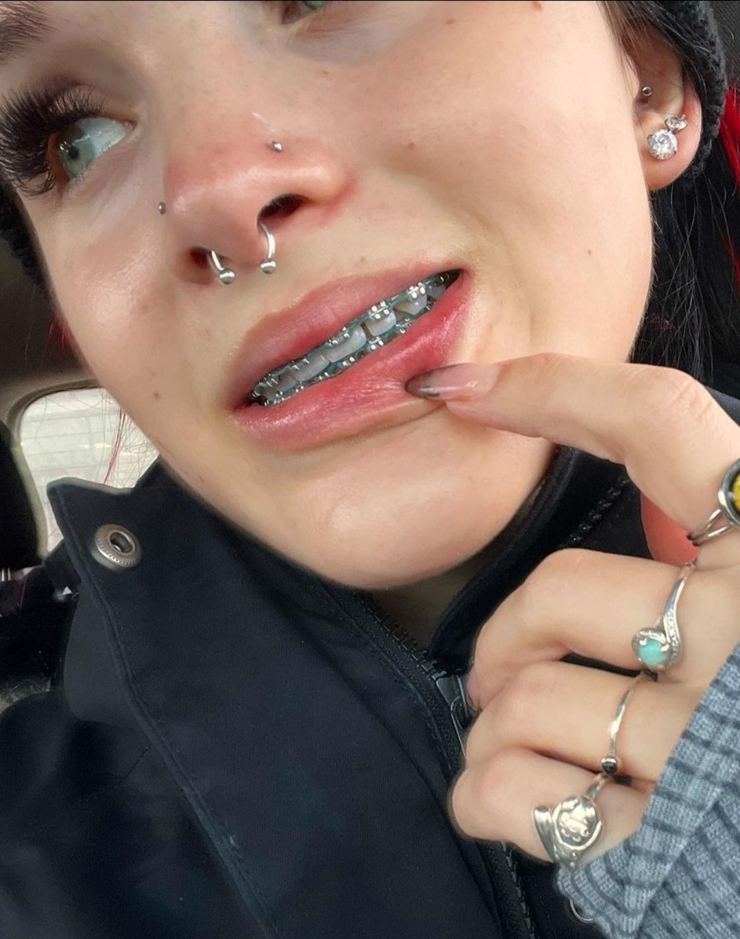 Braces