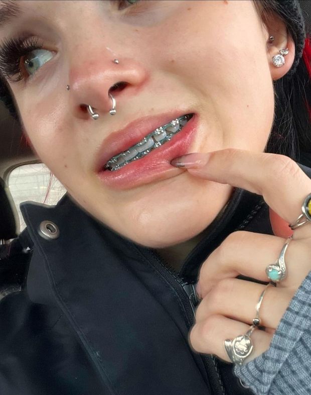Braces