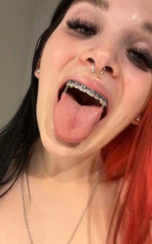Braces tongue