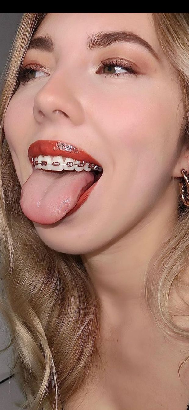 Braces tongue