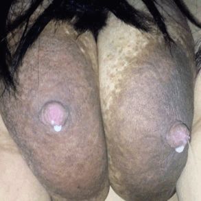Dark squirting areolas