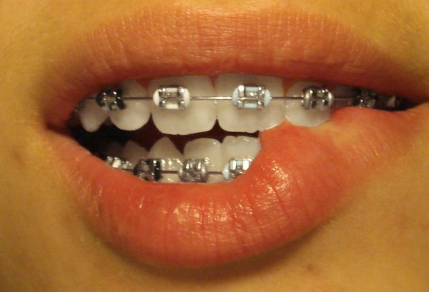 Sexy lips and braces