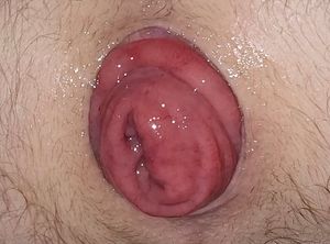 RoseHose420 Prolapse ButtRose