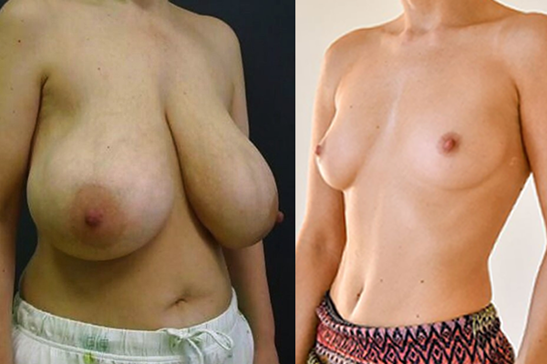 Topless Comparison
