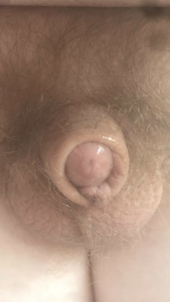 Micropenis