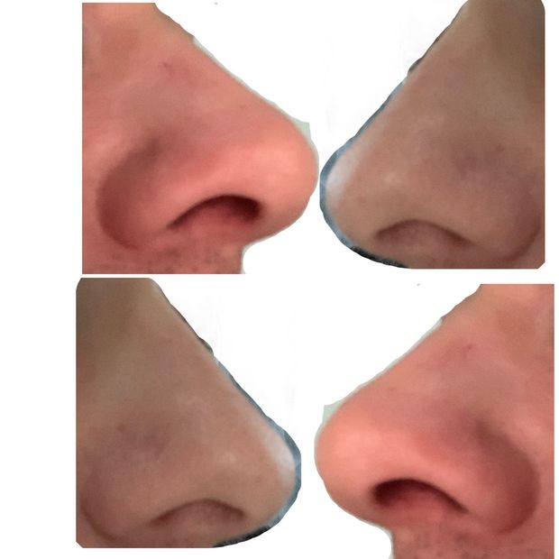 My fucking nose