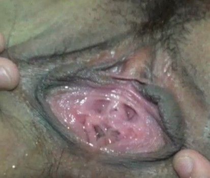 Asian Skene's gland