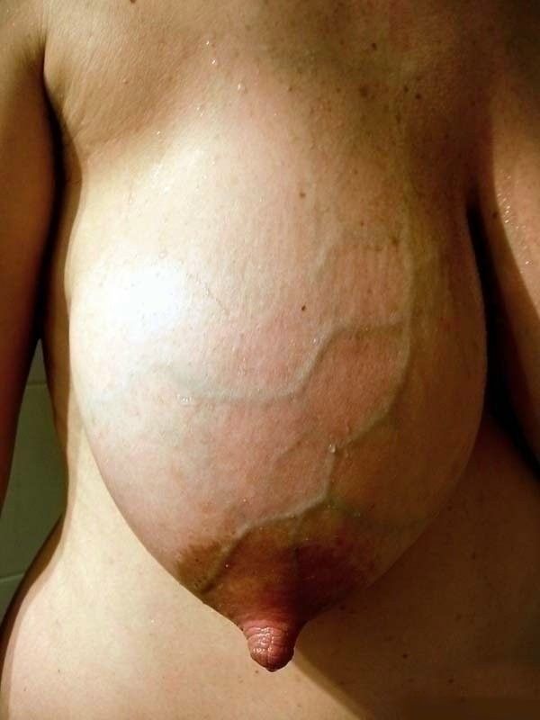 Thick blue veins