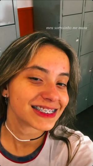 Teen Brazilian Cute Smile Braces at College