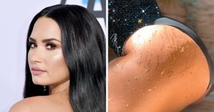 Demi Lovato Stretch Marks