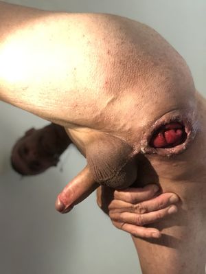 anal opening after big insertion