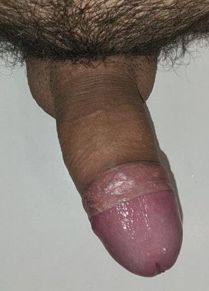 Foreskin pulled back