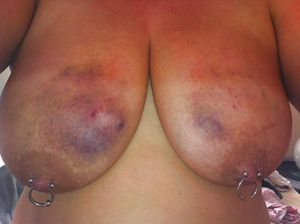 fat and bruised tits