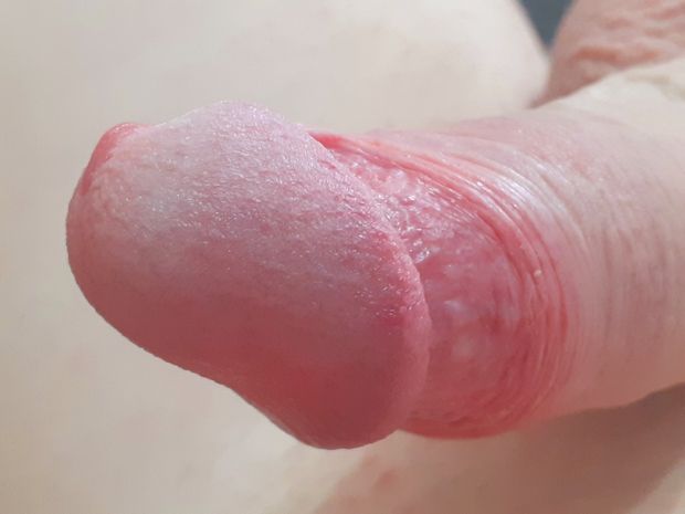 My penis glans