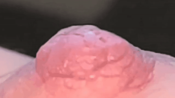 Eruption