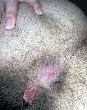Hairy holes