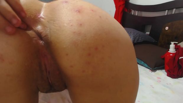 Pimples