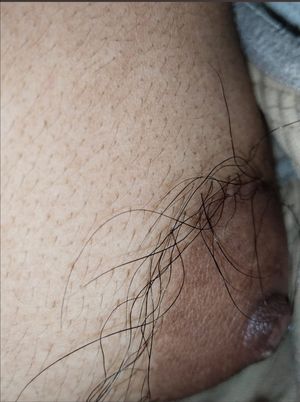 Hairy nipple