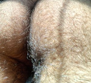 Hairy cheeks