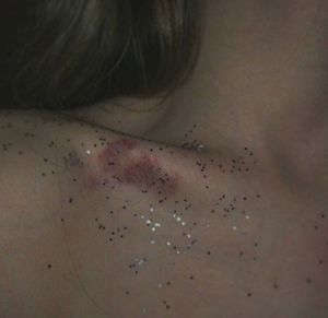 She came home marked with bruises and glitter.