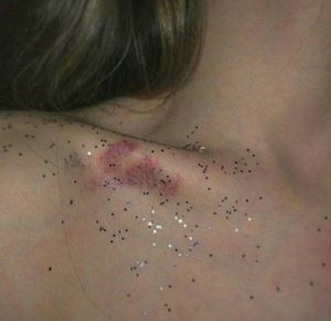 She came home with bruises and glitter.