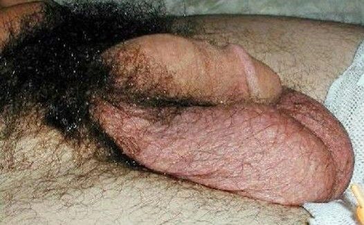 Hairy ball nest