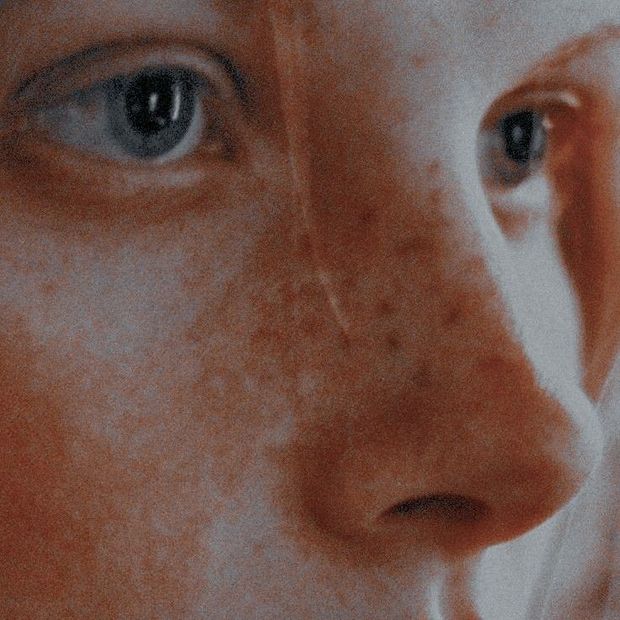 Freckles