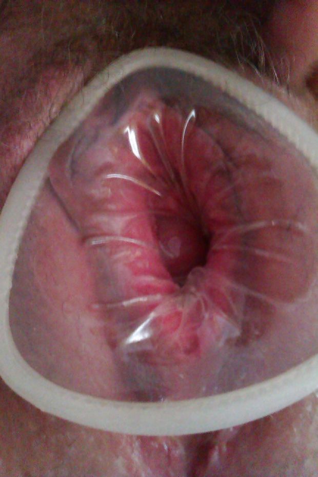 Female Condom