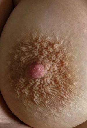 wrinkled areola