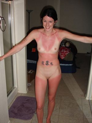 She got sunburnt