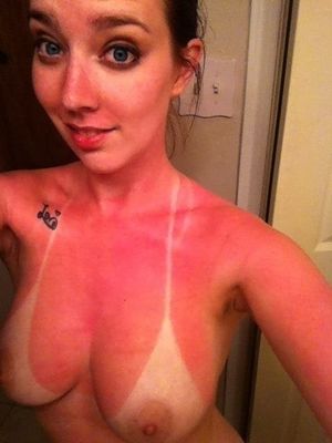 Sunburn Teen