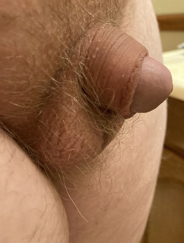 micropenis