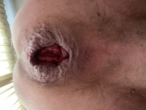 Bimodal anal gape